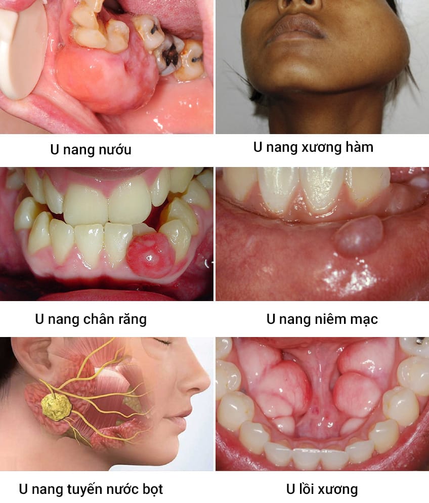Các dạng u nang hàm mặt