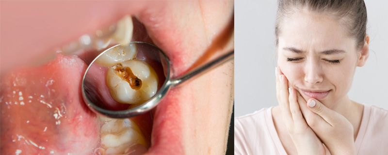 điều trị sâu răng tại nhà