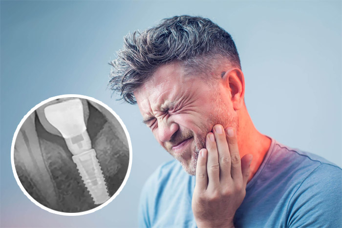 Sưng đau sau khi cấy ghép implant - tác hại của cấy ghép implant