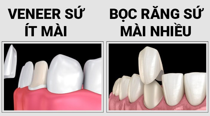 bọc răng sứ ít mài và mài nhiều