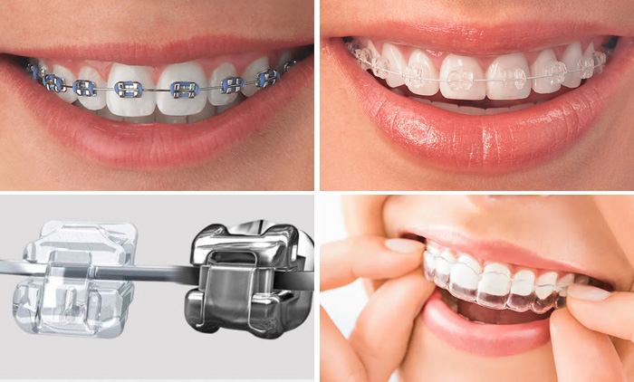 các loại mắc cài phổ biến