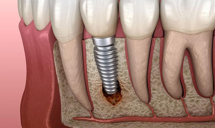 cắm implant thất bại