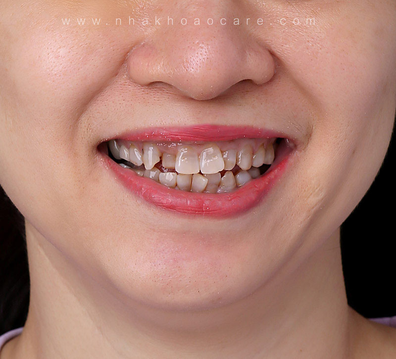 dán sứ veneer đẹp cỡ nào (1)