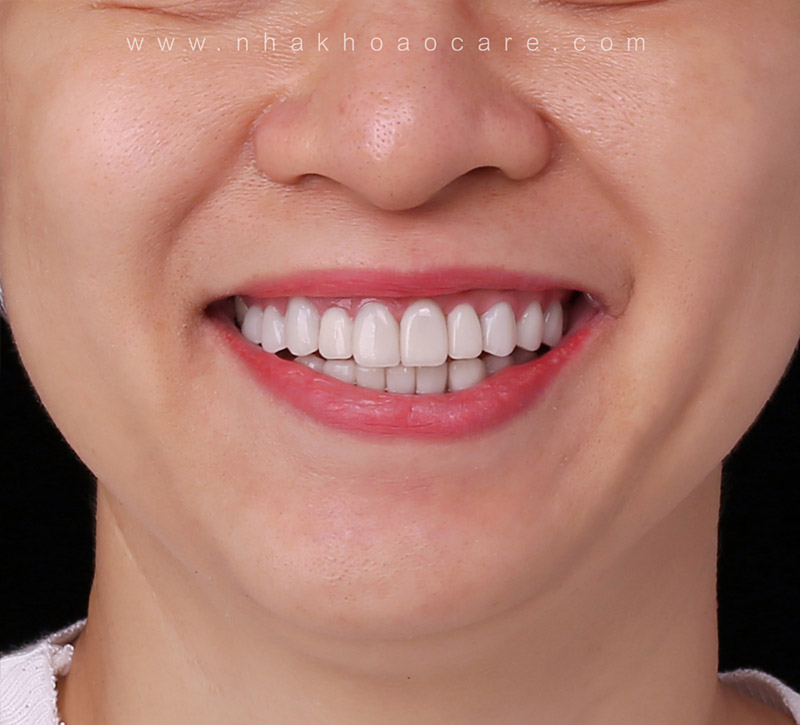 dán sứ veneer đẹp cỡ nào (1)