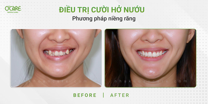 điều trị cười hở nướu bằng phương pháp niềng răng