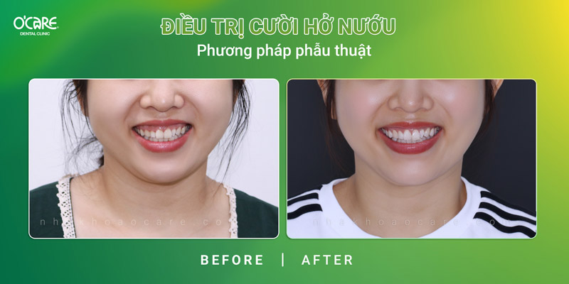 điều trị cười hở nướu bằng phương pháp phẫu thuật cắt nướu