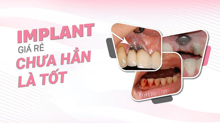 implant giá trẻ có tốt không