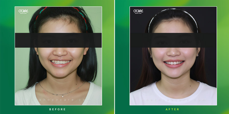 niềng răng điều trị khớp cắn ngược
