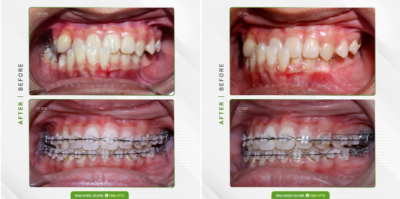 niềng răng điều trị khớp cắn ngược 4
