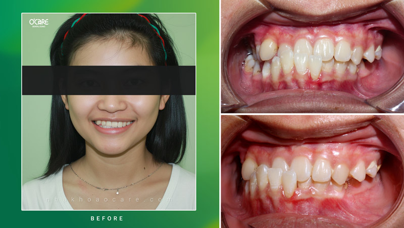 niềng răng điều trị khớp cắn ngược