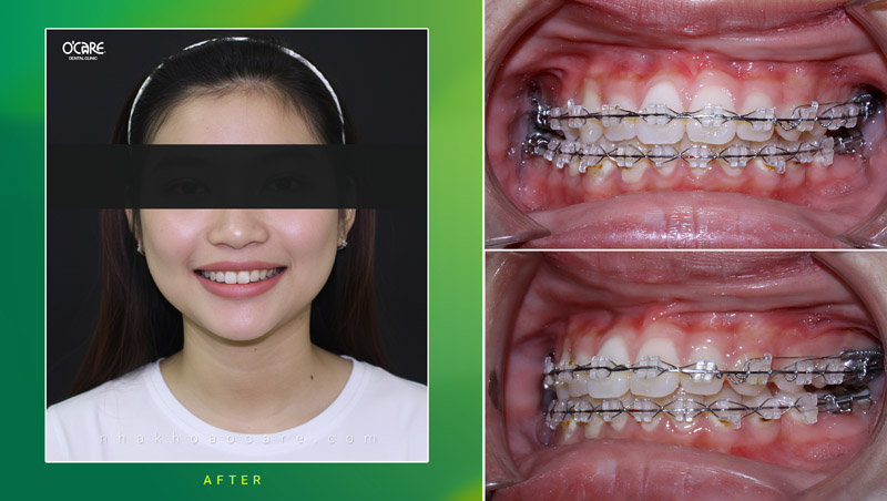 niềng răng điều trị khớp cắn ngượca