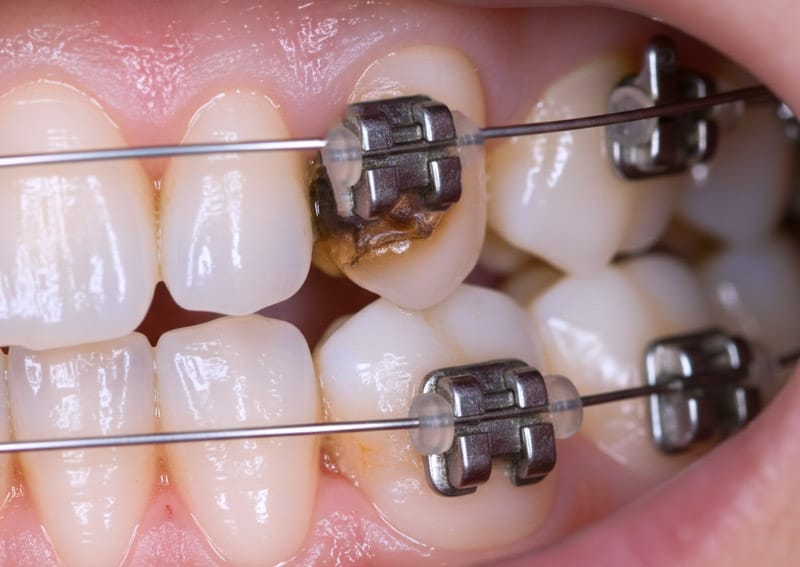 sâu răng khi niềng răng
