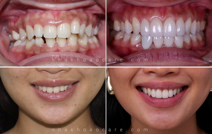 trước và sau Niềng răng invisalign Nha Khoa Ocare 2