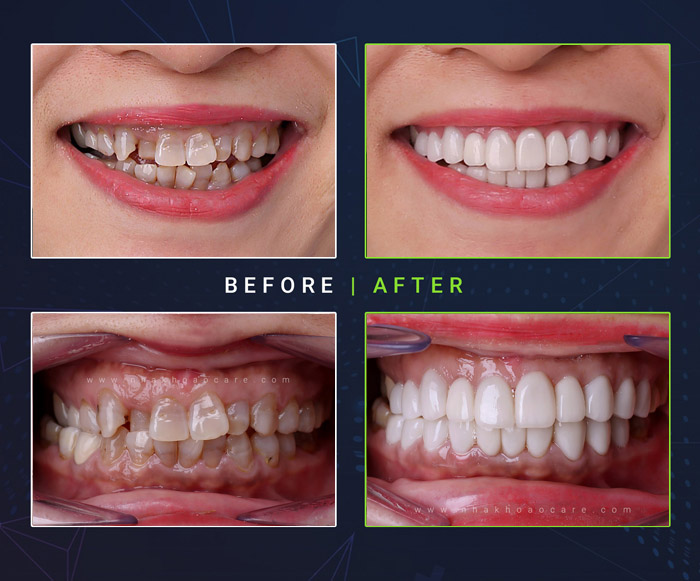 dán răng sứ veneer răng nhiễm tetra sỉn màu