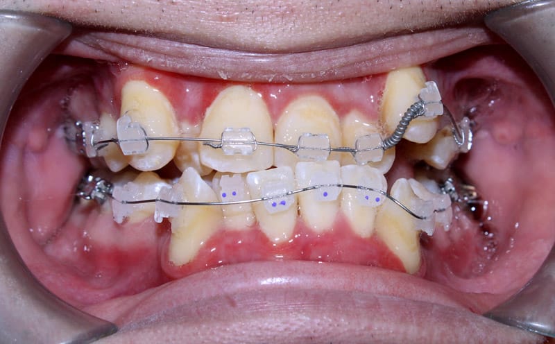 viêm nướu khi niềng răng