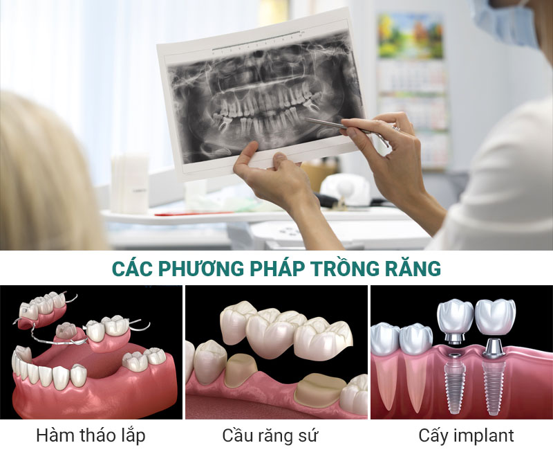 Các phương pháp trồng răng giả