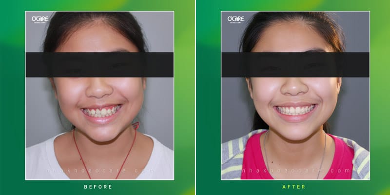 Niềng răng cắn chéo 5