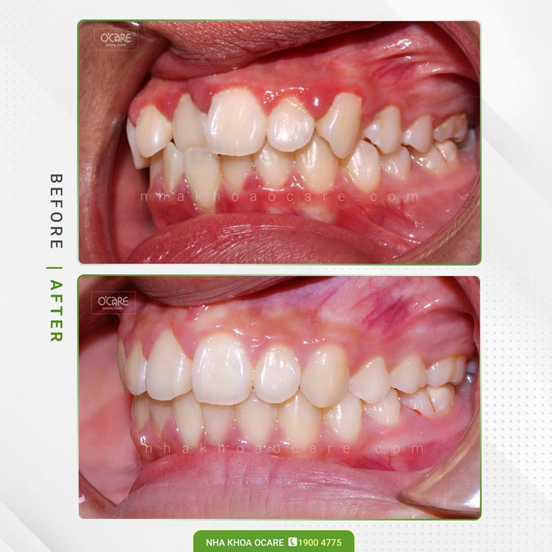 Niềng răng cắn chéo 5