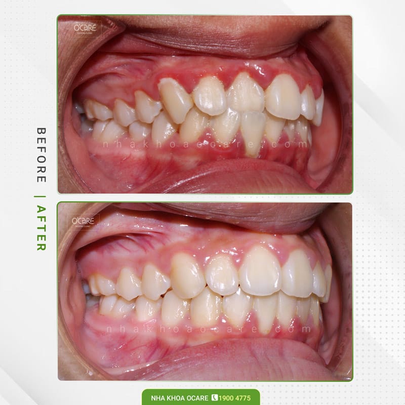 Niềng răng cắn chéo 5