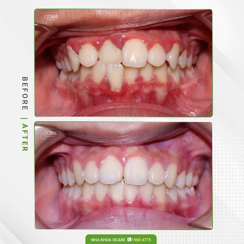 Niềng răng cắn chéo 5