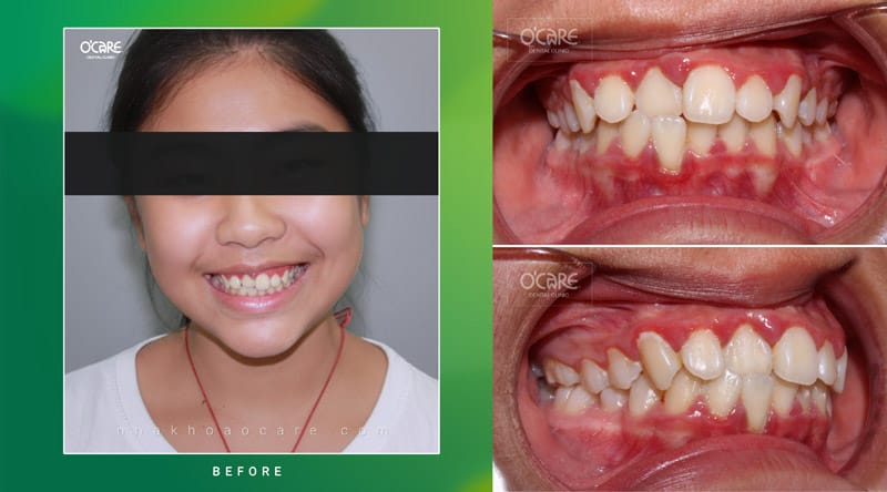 Niềng răng cắn chéo