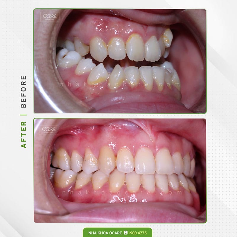 Niềng răng chỉnh nha Geaw