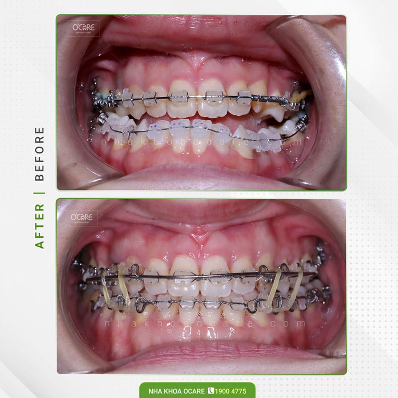 Niềng răng chỉnh nha Geaw