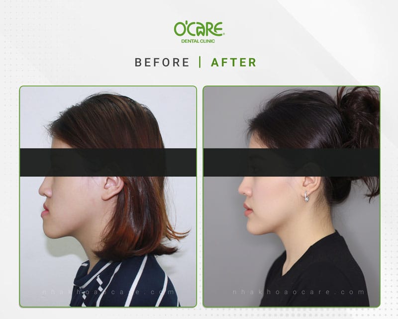 Niềng răng chỉnh nha Geaw