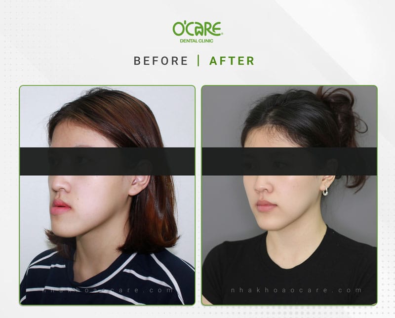 Niềng răng chỉnh nha Geaw