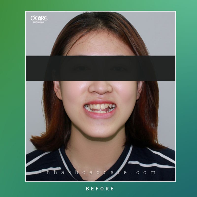 Niềng răng chỉnh nha Geaw