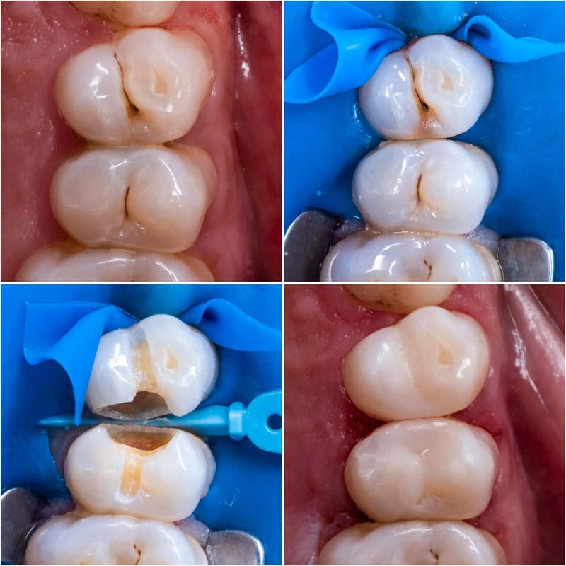 Quy trình trám răng sữa