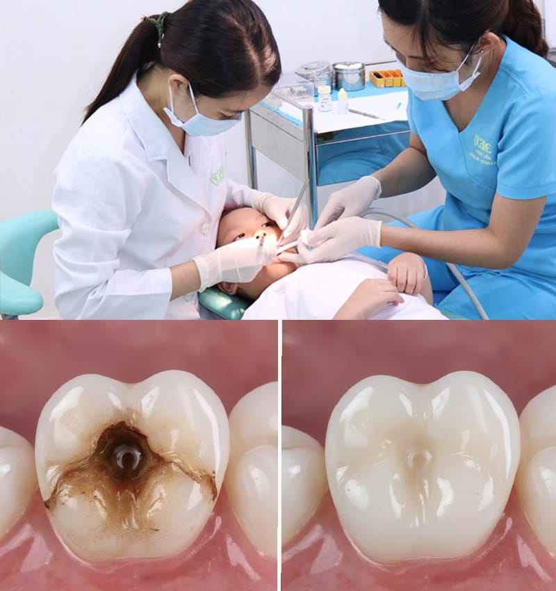 Trám răng sữa giá bao nhiêu a