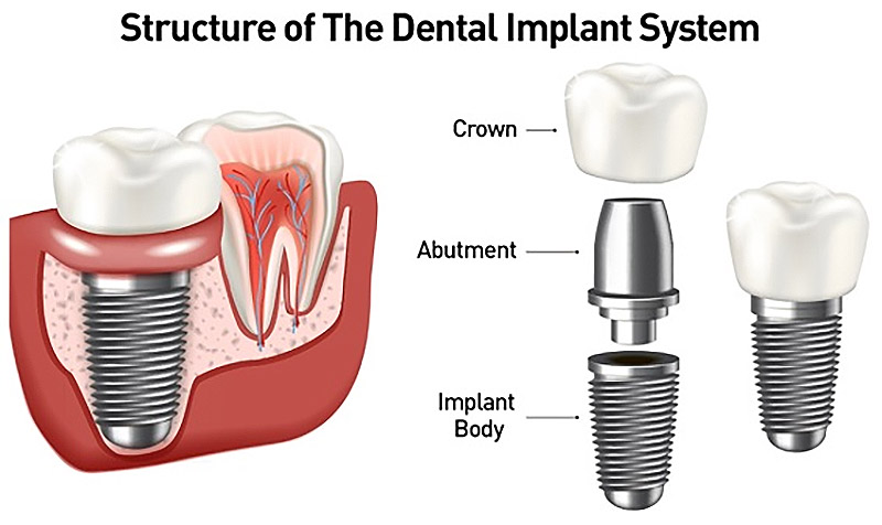 implant system