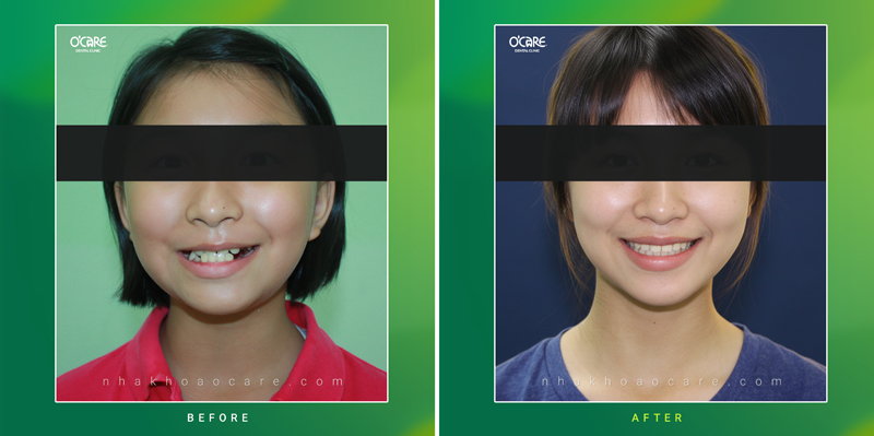 niềng răng cắn ngược (móm) trẻ em 4