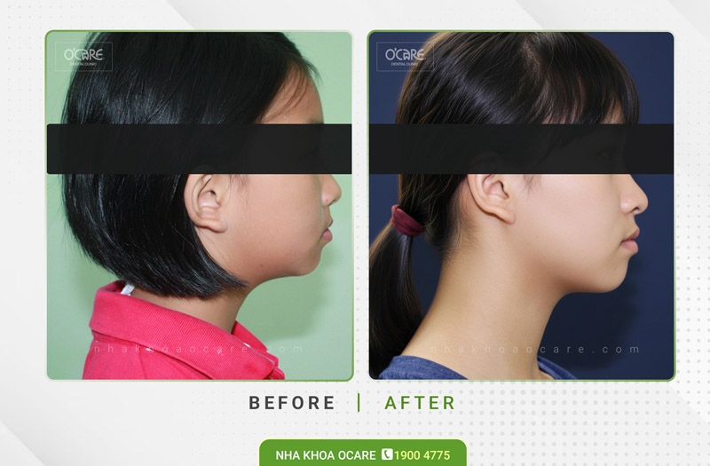 niềng răng cắn ngược (móm) trẻ em 4