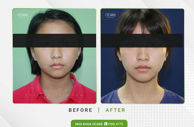 niềng răng cắn ngược (móm) trẻ em 4