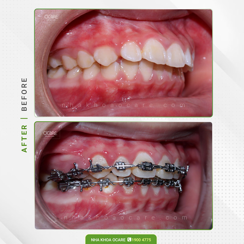niềng răng hô trẻ em (7)