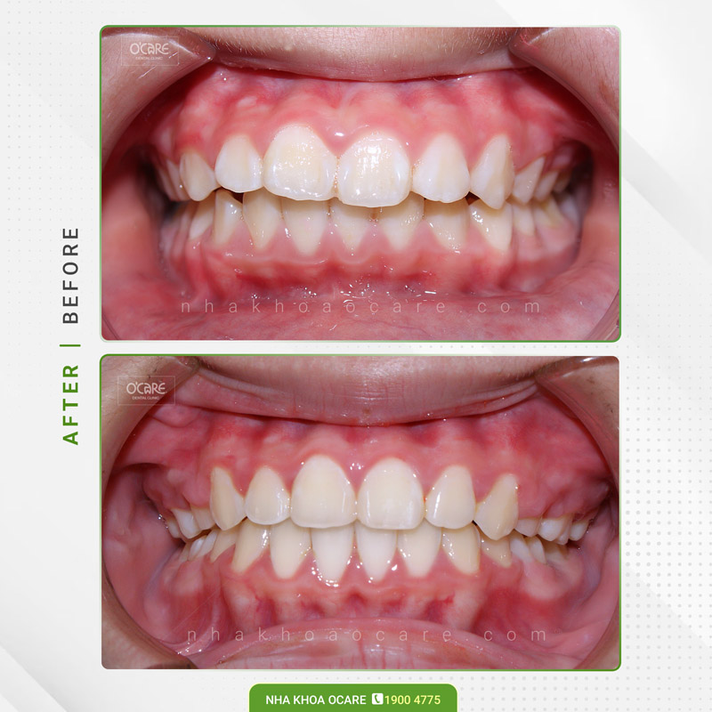 niềng răng hô trẻ em (7)