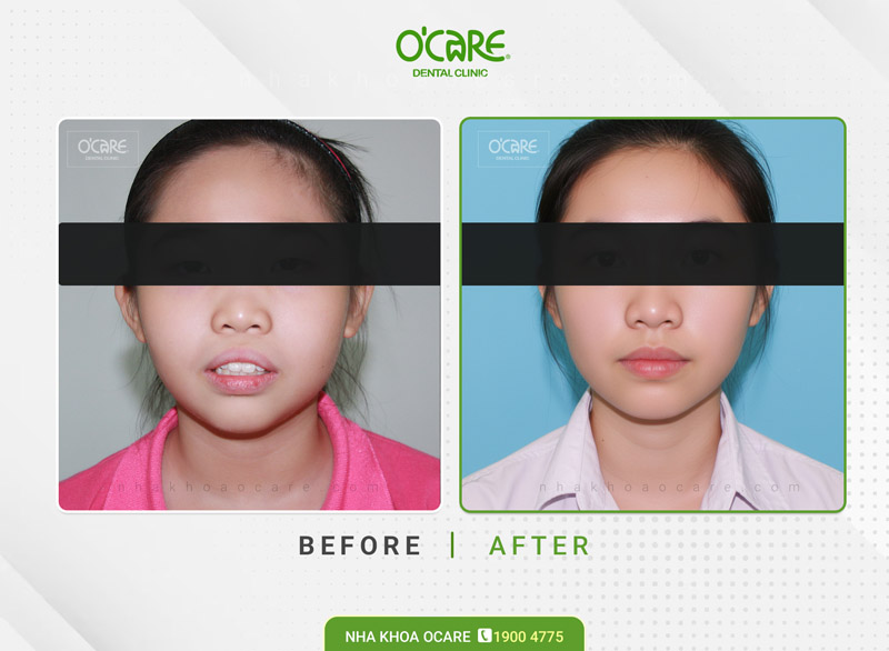 niềng răng hô trẻ em (7)