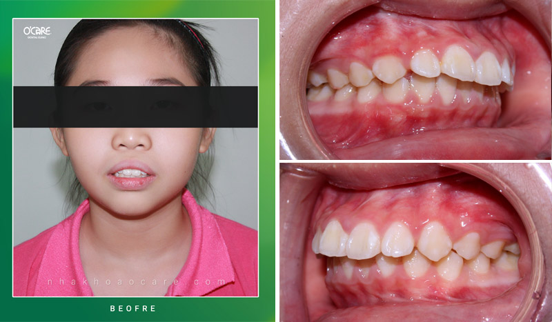 niềng răng hô trẻ em