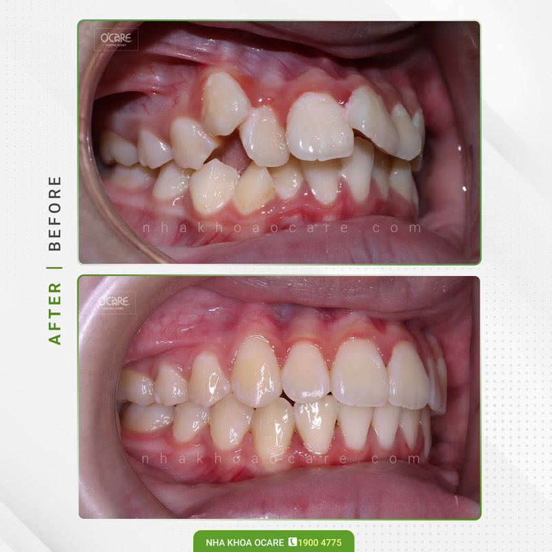 niềng răng khấp khểnh và hô ở trẻ em (1)