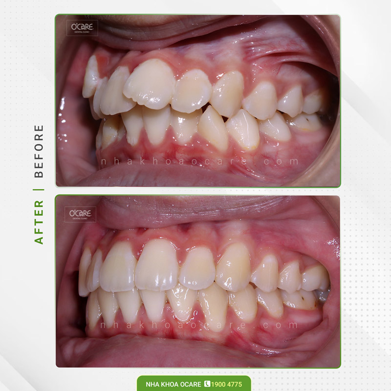 niềng răng khấp khểnh và hô ở trẻ em (1)