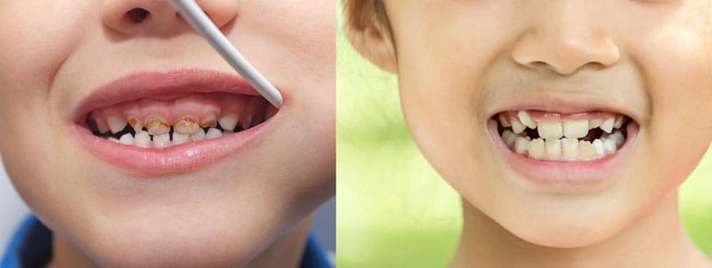 tác hại của sâu răng sữa