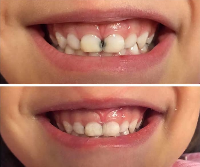 trám răng cửa sâu trẻ em