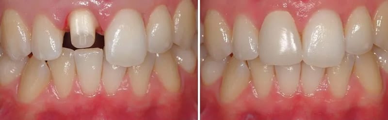 Bọc răng sứ gãy răng cửa