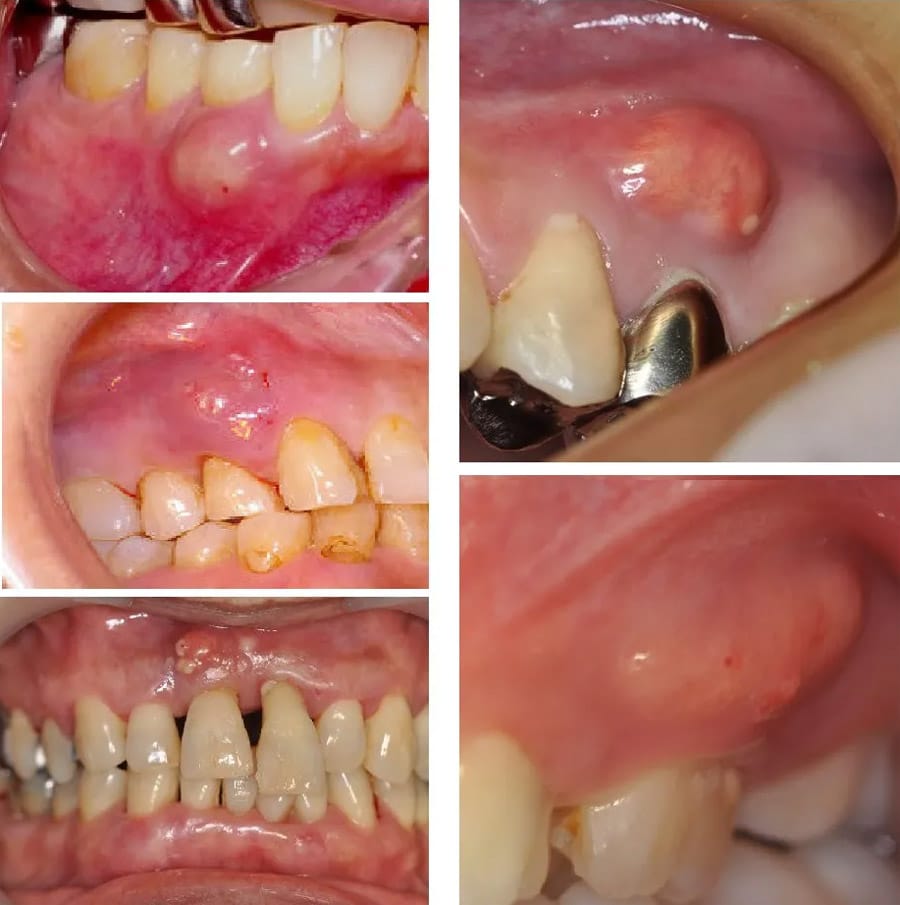 Dấu hiệu răng Nhiễm Trùng apxe