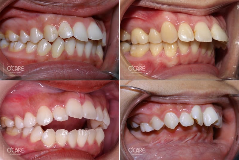 Niềng răng hô bao lâu 1