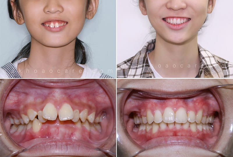 Niềng răng hô bao lâu 2