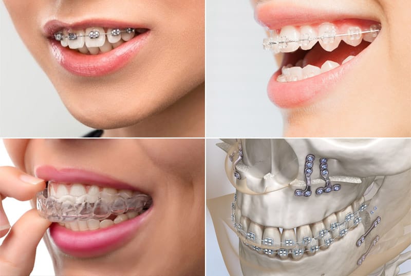 Niềng răng hô bao lâu 3
