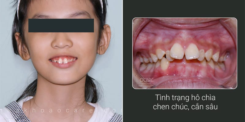 Niềng răng hô bao lâu